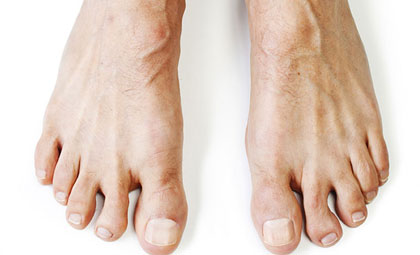Flat-Feet-Los-Angeles-Foot-and-Ankle-Surgeon-1