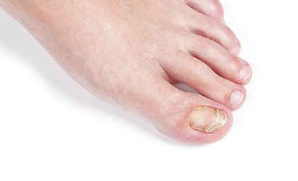 Laser-Nail-Fungal-Treatment—Los-Angeles-Foot-and-Ankle-Surgeon–(2)
