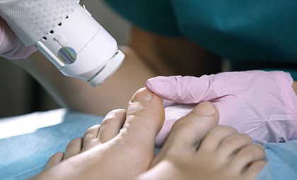 Laser-Nail-Fungal-Treatment—Los-Angeles-Foot-and-Ankle-Surgeon
