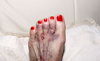 Mortons-Neuroma-Los-Angeles-Foot-and-Ankle-Surgeon-2-2