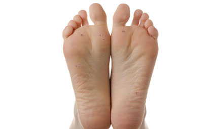 Warts-Los-Angeles-Foot-and-Ankle-Surgeon-2