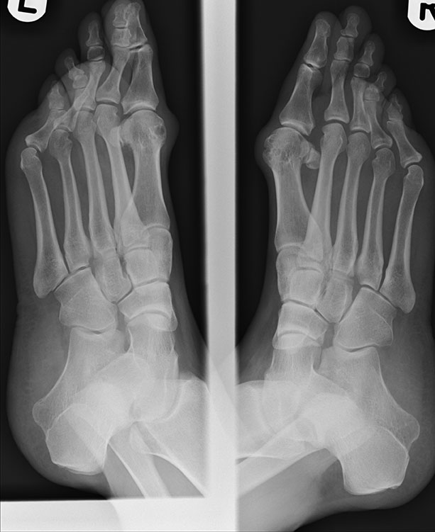 Bunions - Foot & Ankle Institute of the West