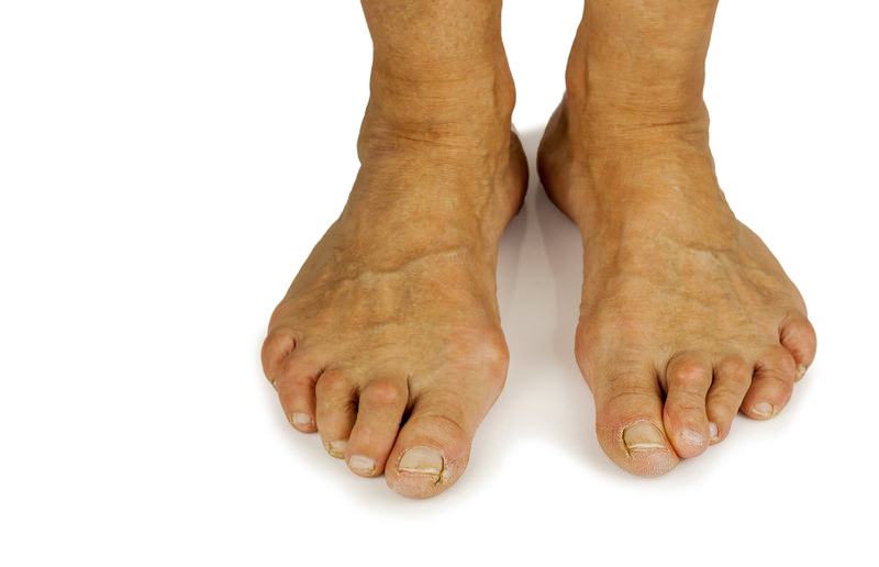 Bunion Removal Surgery - Los Angeles Foot and Ankle Surgeon-2