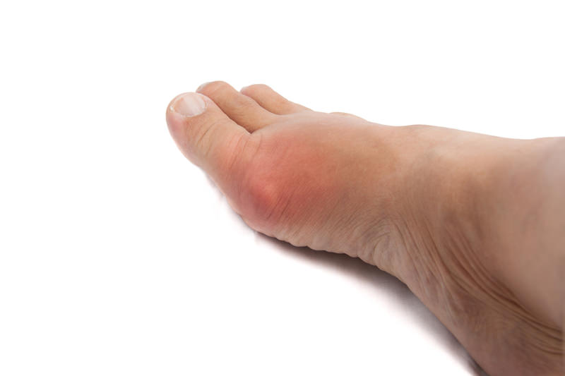 Bunion Removal Surgery - Los Angeles Foot and Ankle Surgeon-4