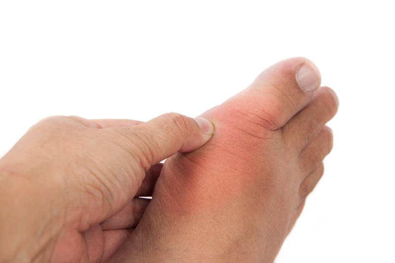 Bunion Removal Surgery - Los Angeles Foot and Ankle Surgeon-5