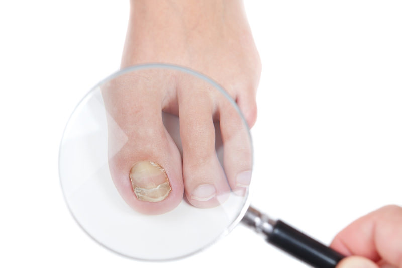 Laser Nail Fungus Treatment - Los Angeles Foot and Ankle Surgeon-2