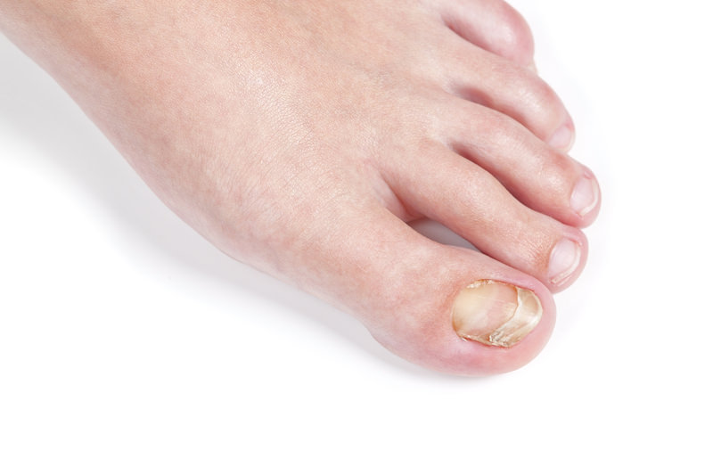 Laser Nail Fungus Treatment - Los Angeles Foot and Ankle Surgeon-3