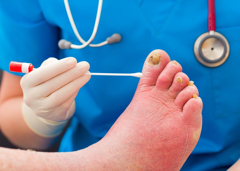 Laser Nail Fungus Treatment - Los Angeles Foot and Ankle Surgeon-5