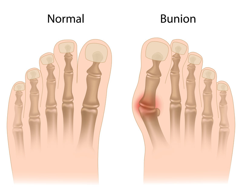 Orthotics for Bunions - Los Angeles Foot and Ankle Surgeon-1