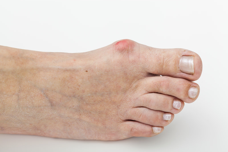 Orthotics for Bunions - Los Angeles Foot and Ankle Surgeon-2