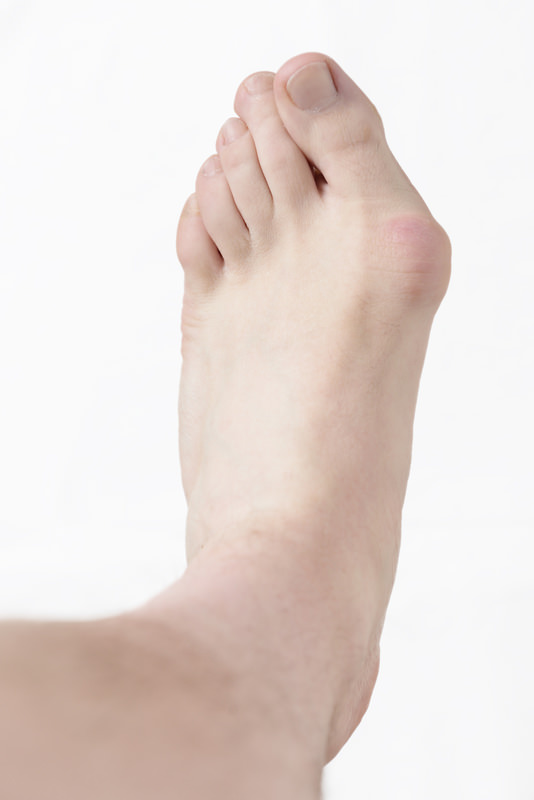 Orthotics for Bunions - Los Angeles Foot and Ankle Surgeon-4