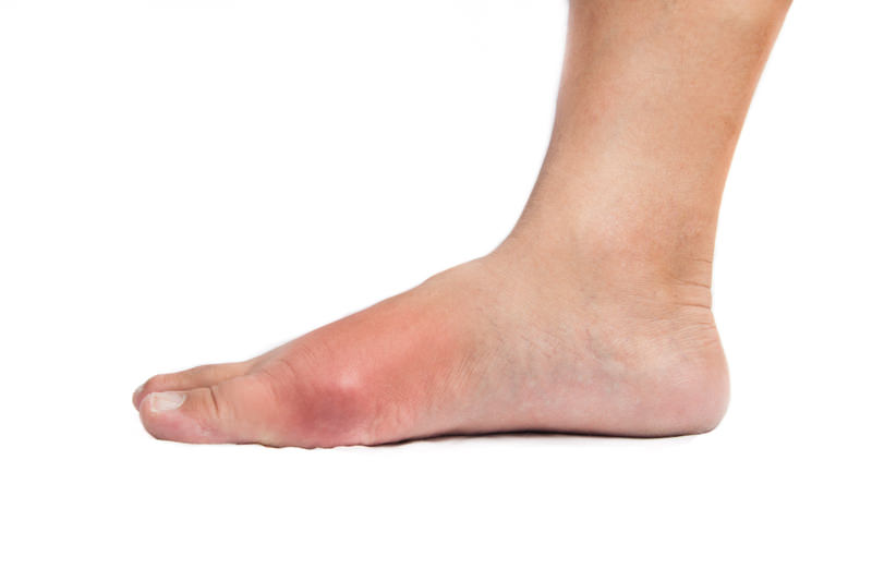 Surgical Treatment for Bunions - Los Angeles Foot and Ankle Surgeon-2