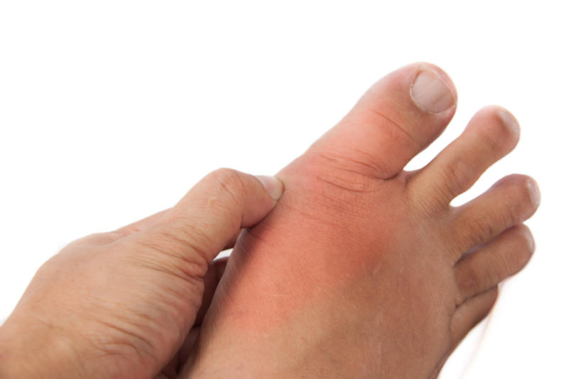 Surgical Treatment for Bunions - Los Angeles Foot and Ankle Surgeon-3