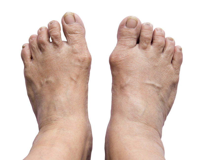 Surgical Treatment for Bunions - Los Angeles Foot and Ankle Surgeon-4