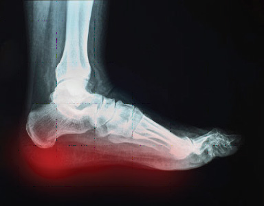 Heel-Pain-Los-Angeles-Foot-and-Ankle-Surgeon-2