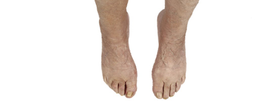 4 Diabetic Foot Care Steps—Dr