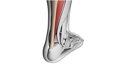 Achilles-Tendonitis-Los-Angeles-Foot-and-Ankle-Surgeon-2