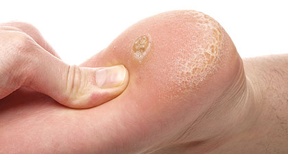 The Hard Facts About Foot Calluses - DermMedica