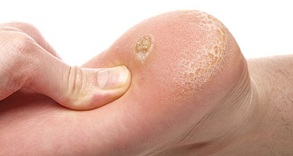 Skin fissure deals big toe