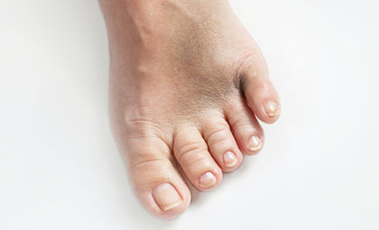 Foot fissures store treatment