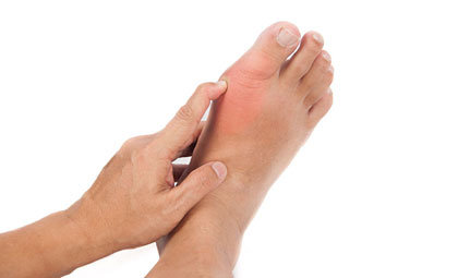 Gout-Los-Angeles-Foot-and-Ankle-Surgeon-1-1