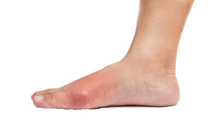 Gout-Los-Angeles-Foot-and-Ankle-Surgeon-2