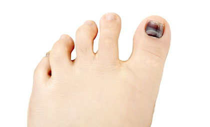 Hammertoes-Los-Angeles-Foot-and-Ankle-Surgeon-1-1