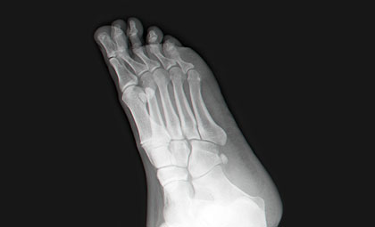 Hammertoes-Los-Angeles-Foot-and-Ankle-Surgeon-2