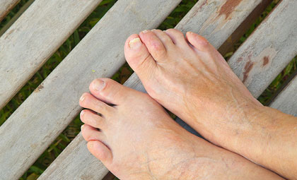 Ingrown-Toenails-Other-Nail-Issues-Los-Angeles-Foot-and-Ankle-Surgeon-1-1