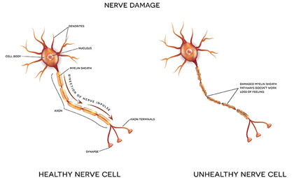 Peripheral-Neuropathy-Los-Angeles-Foot-and-Ankle-Surgeon-2-1