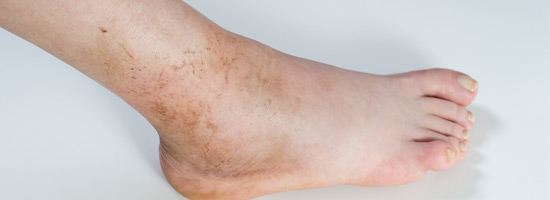 When Should You See A Doctor For An Ankle Sprain?