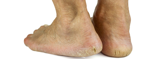 Treatments And Prevention Of Cracked Heels Dr Quinn Fauria