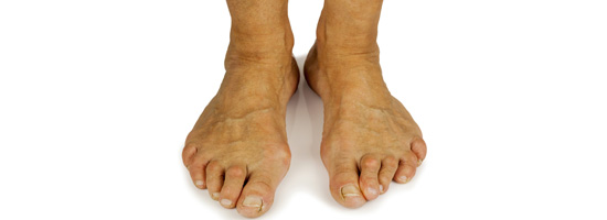 4 Bunion Treatment Tips Los Angeles Foot And Ankle
